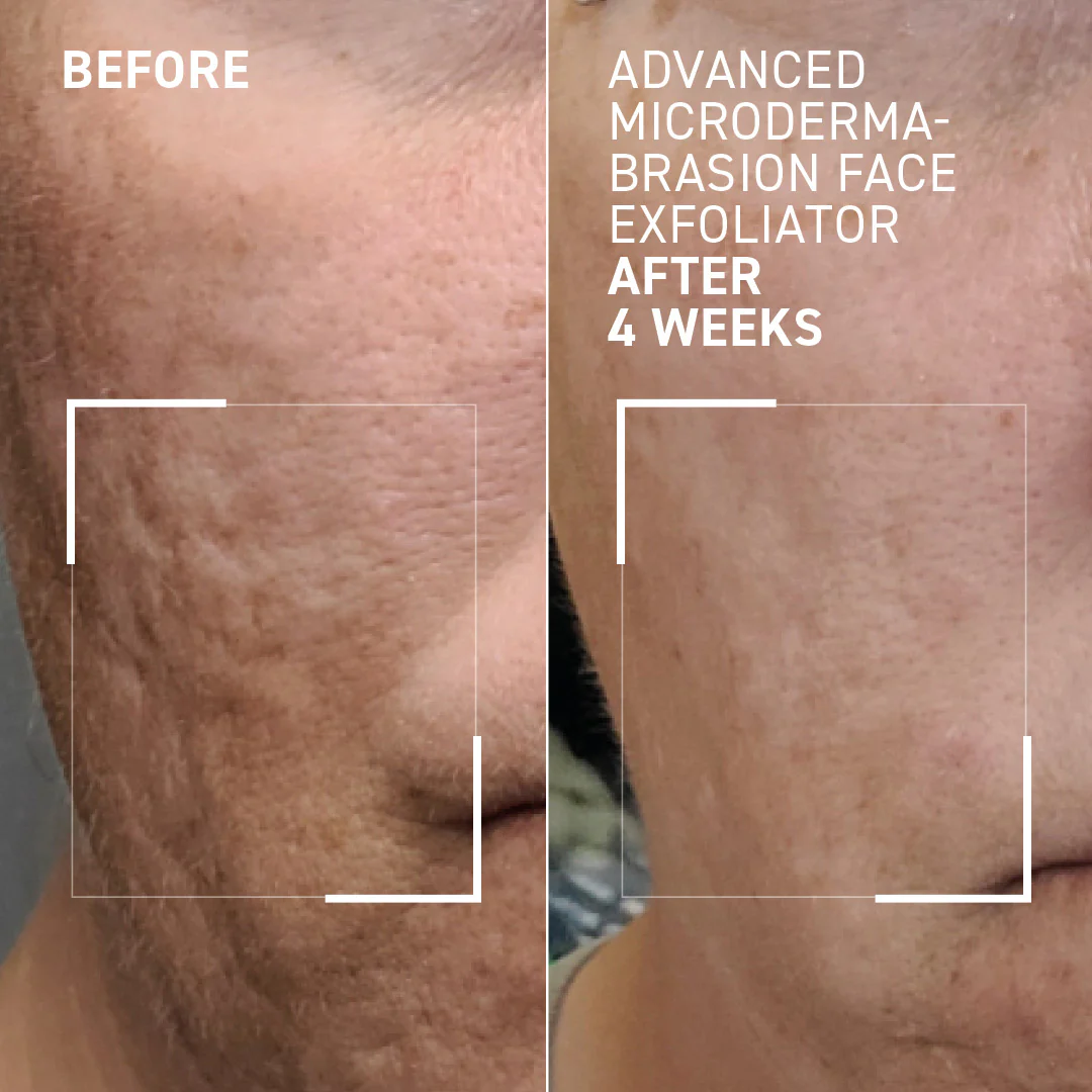 Advanced Microdermabrasion Face Exfoliator - Image 3