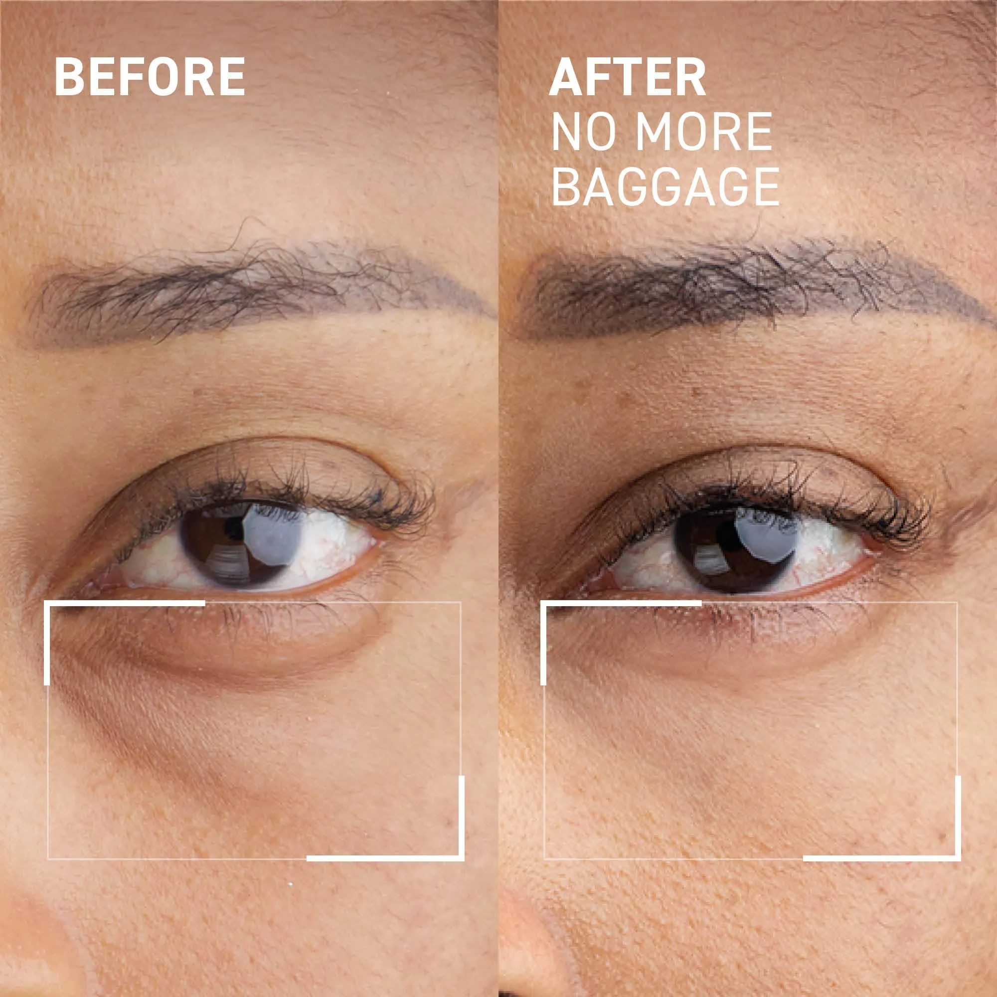 Needles No More No More Baggage Eye Gel 7g - Image 6