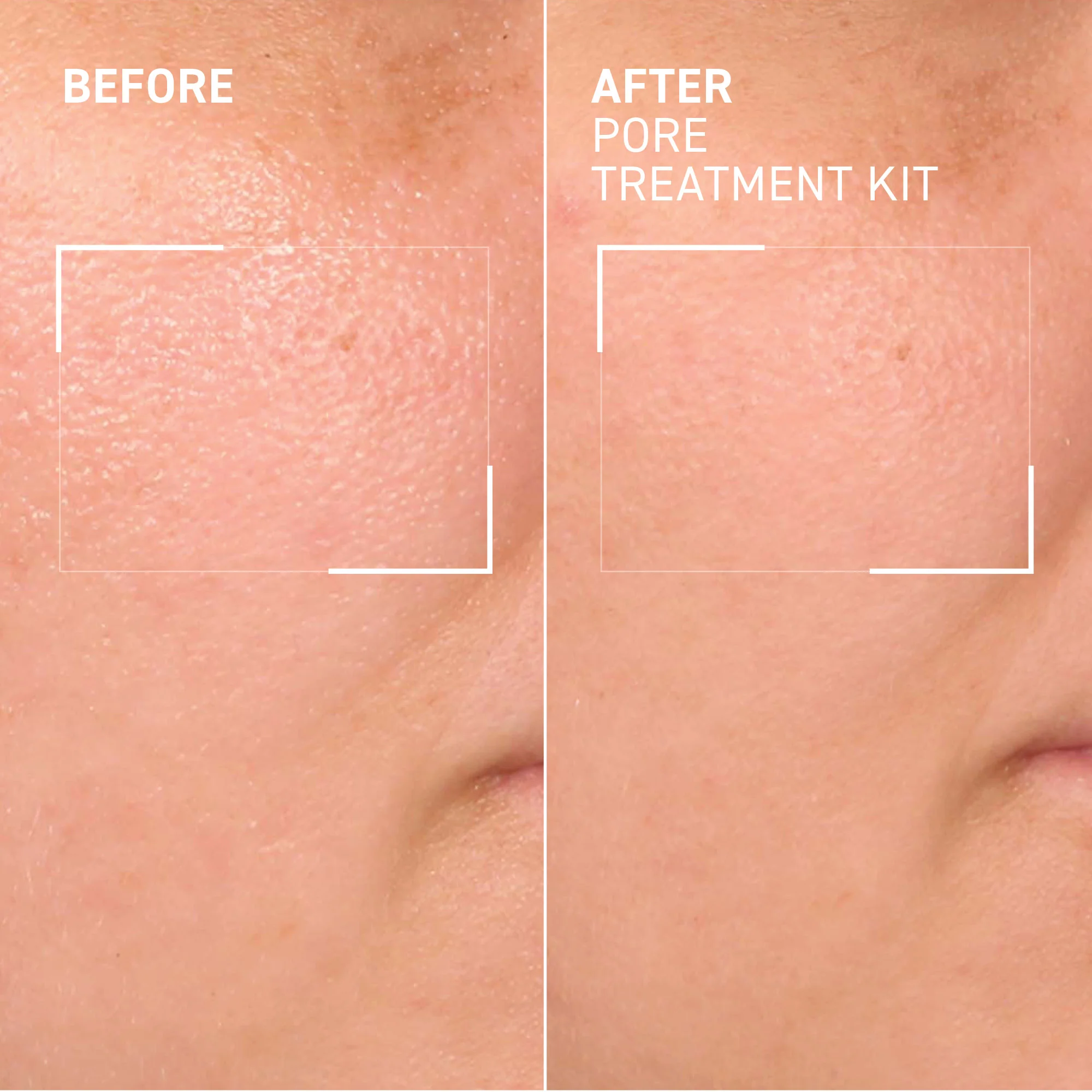 Pore Refining Treatment Kit - Image 3