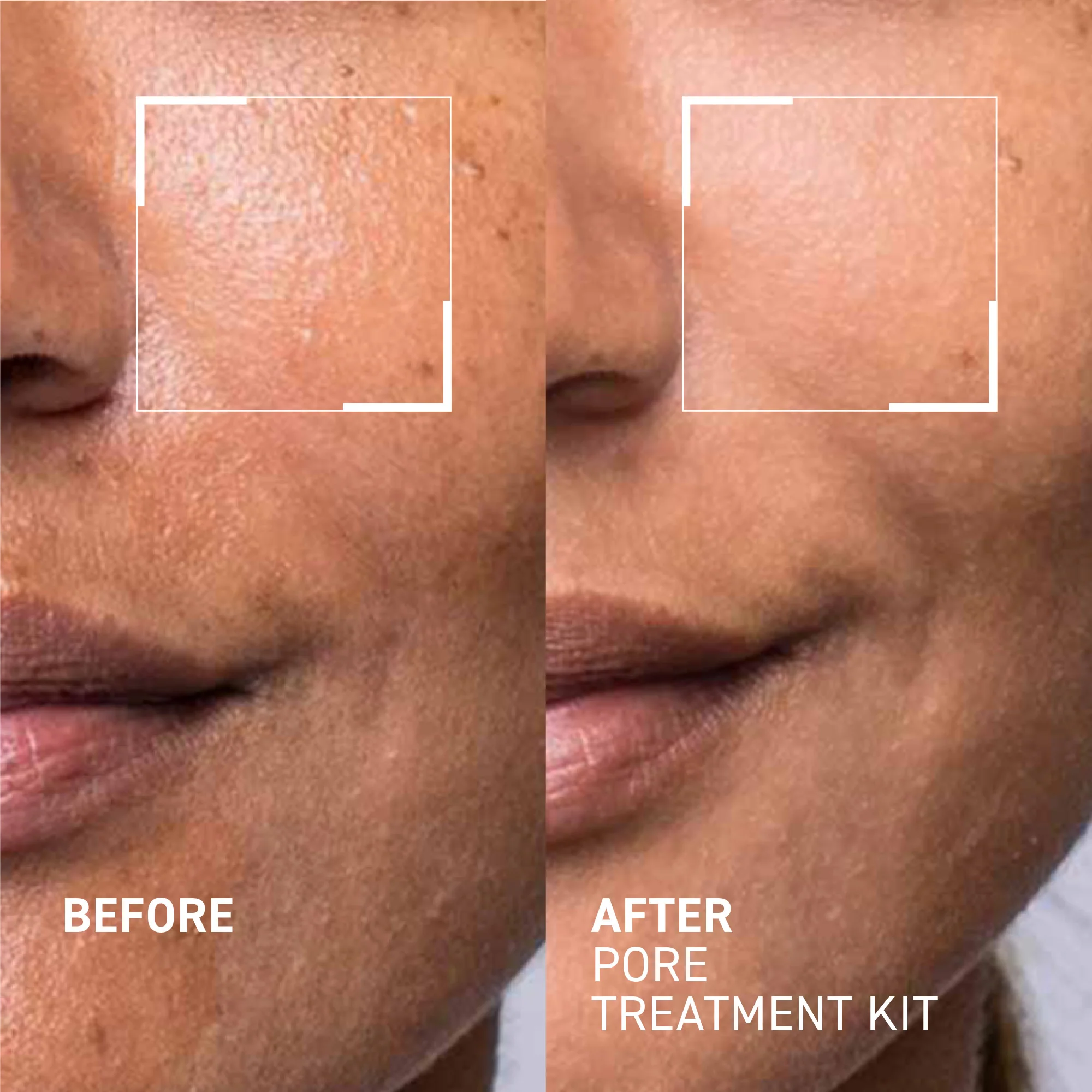 Pore Refining Treatment Kit - Image 4