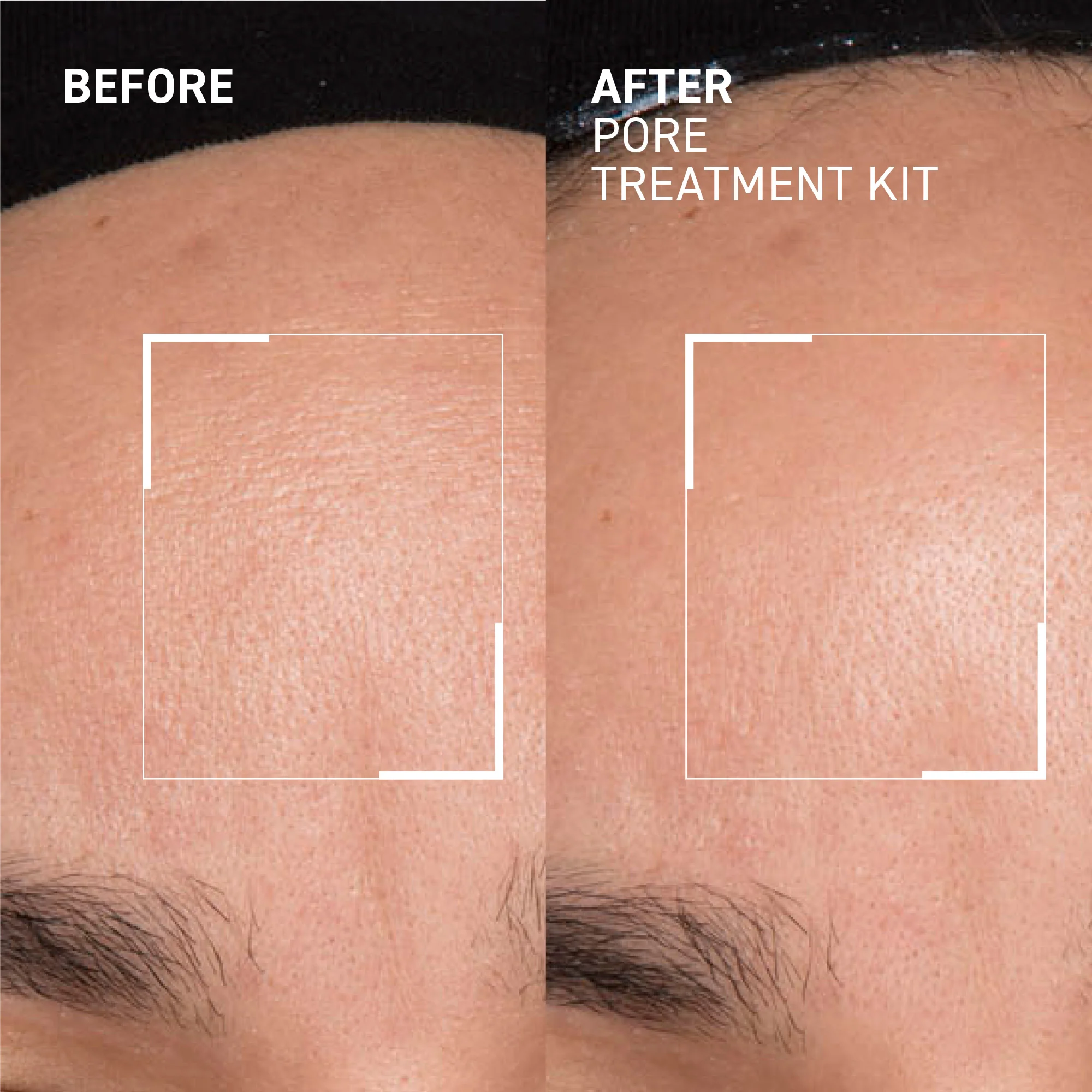 Pore Refining Treatment Kit - Image 5